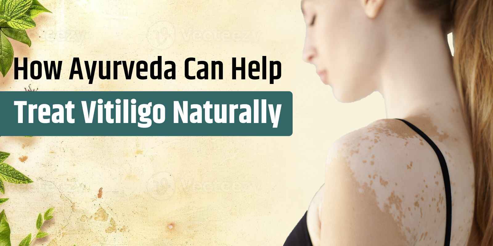 How Ayurveda Can Help Treat Vitiligo Naturally